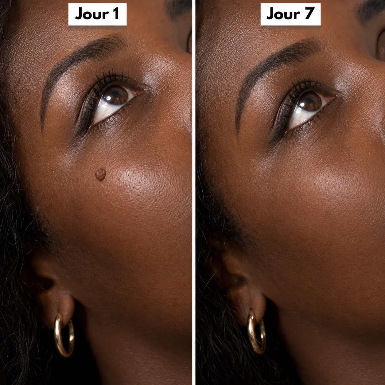 Éliminez ces excroissances en quelques jours, sans douleur 5