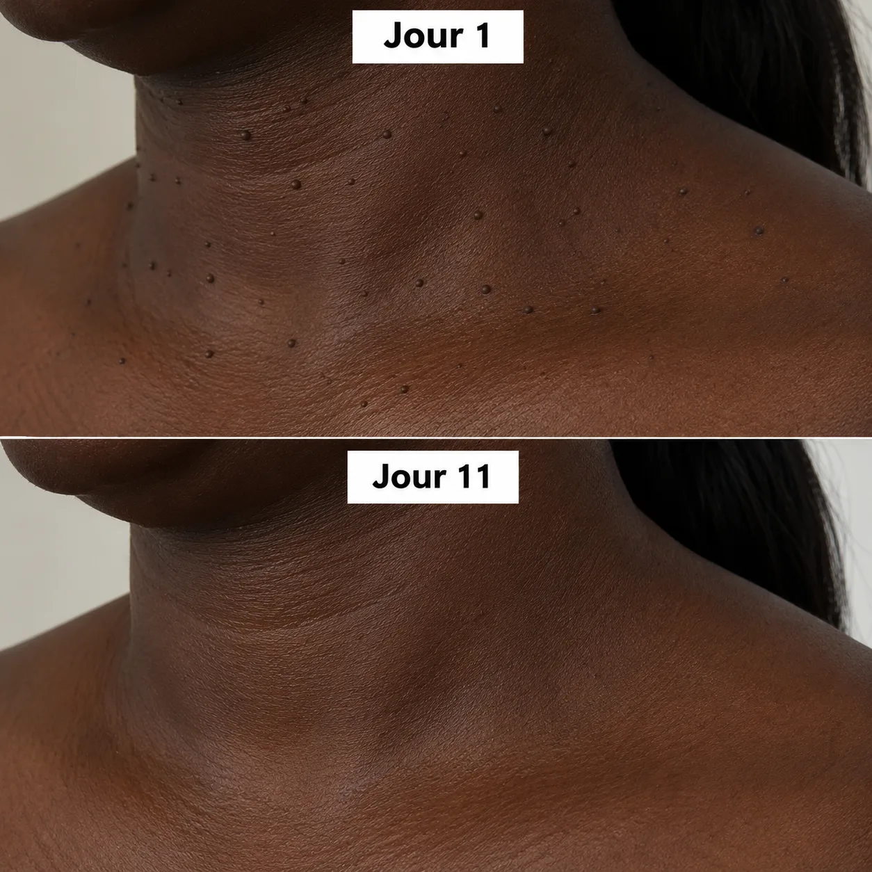 Éliminez ces excroissances en quelques jours, sans douleur 4