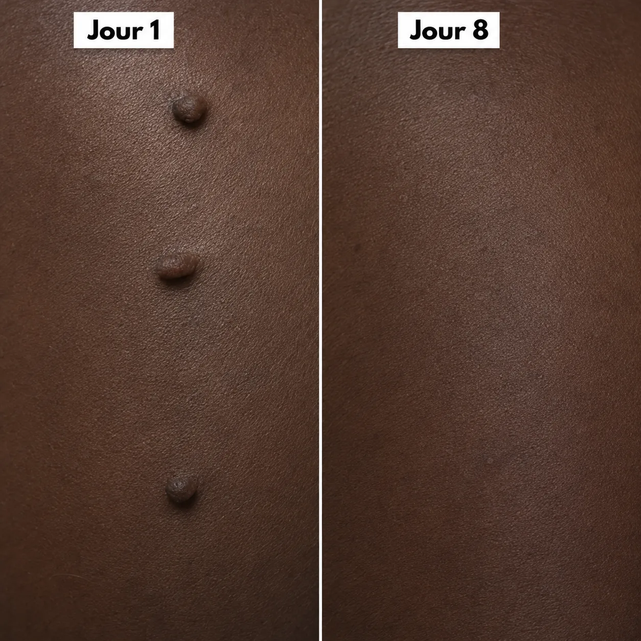 Éliminez ces excroissances en quelques jours, sans douleur 6